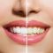 راههای خانگی از بین بردن جرم دندان
