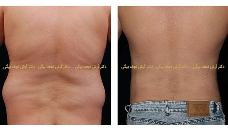 قبل و بعد لیپوماتیک شکم و پهلو