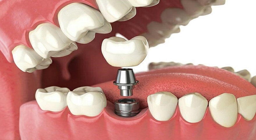 مراقبت از ايمپلنت دندان