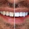 جلوگیری از عوارض کامپوزیت دندان در کلینیک دندانپزشکی سریتا