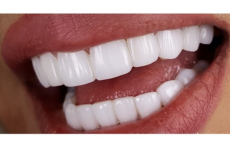 بهترین روش ها و راهکاری های ایمپلنت دندان