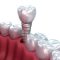 حداقل سن برای کاشت ایمپلنت دندان چقدر است؟