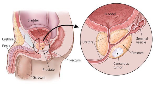 انواع سرطان پروستات