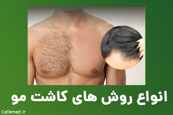 کاشت مو در مشهد