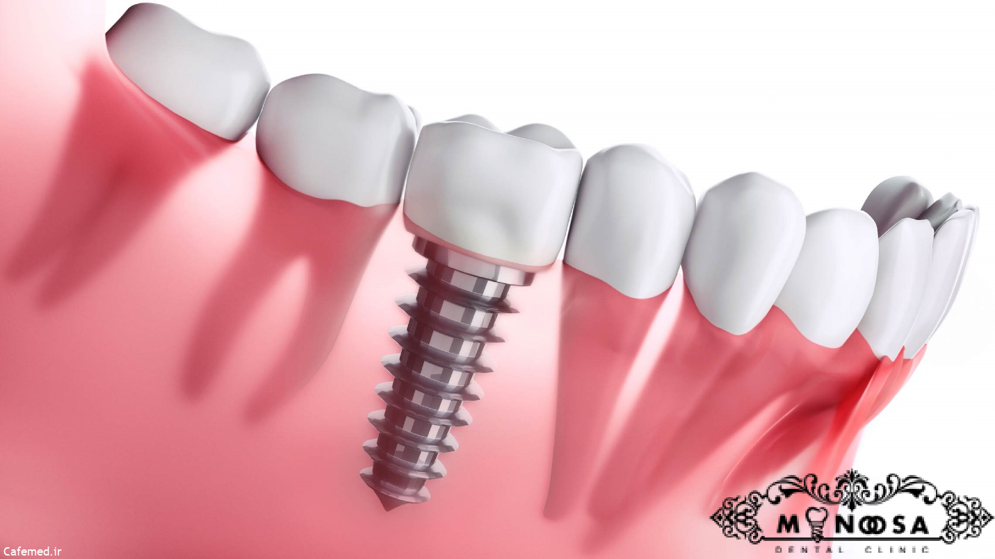 ایمپلنت دندان چیست؟ مزایا و معایب آن کدام اند؟