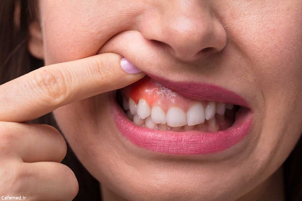 سرطان دهان چیست؟