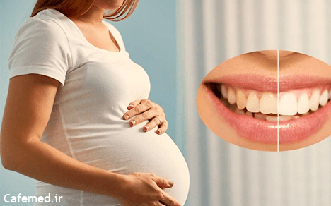 آیا در دوران بارداری میتوان بلیچینگ دندان انجام داد؟