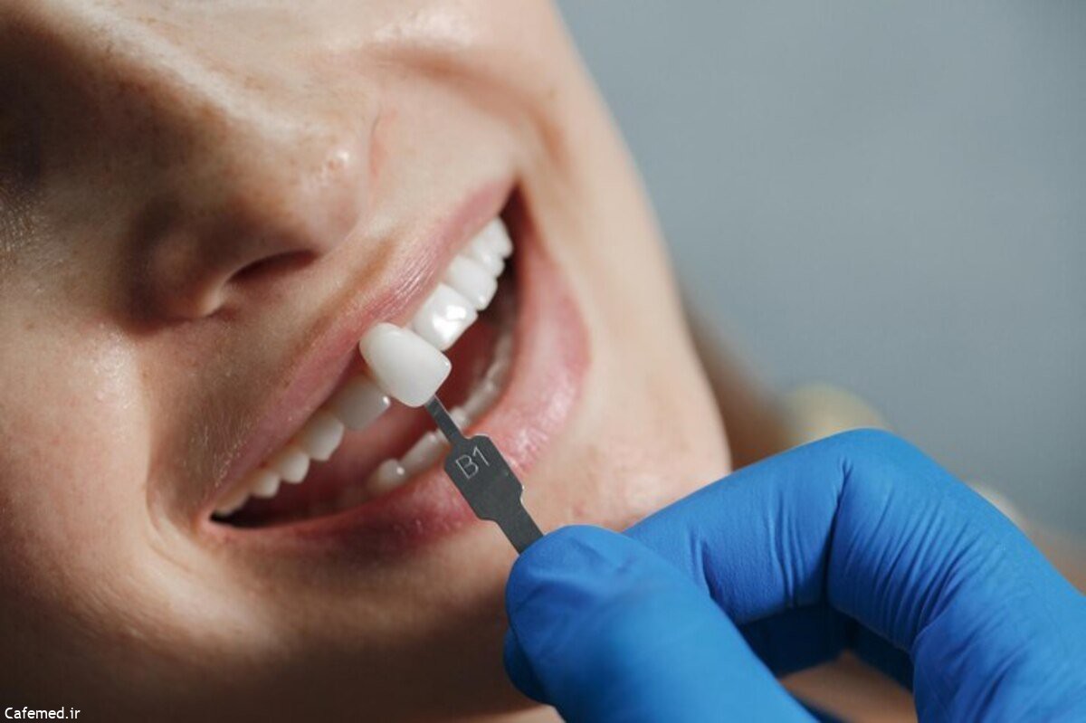 مزایای لمینیت کردن دندان