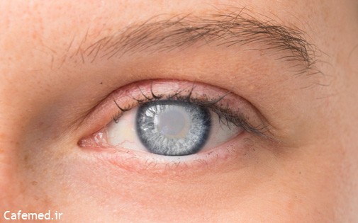 آیا افراد دارای قوز قرنیه می‌توانند عمل‌های لیزری چشم را انجام دهند؟