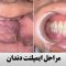 مراحل ایمپلنت دندان (۴ مرحله اصلی کاشت ایمپلنت)
