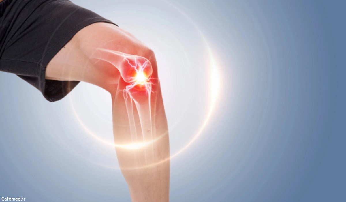 درد عصبی ممکن است منجر به بروز زانو درد شود.