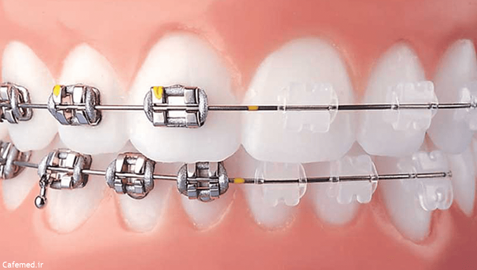 انواع ارتودنسی دندان؛ کاربردها و ویژگی‌ها
