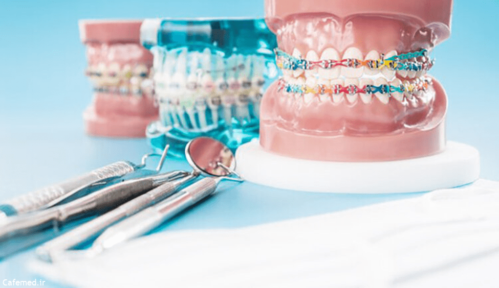 ارتودنسی لینگوال